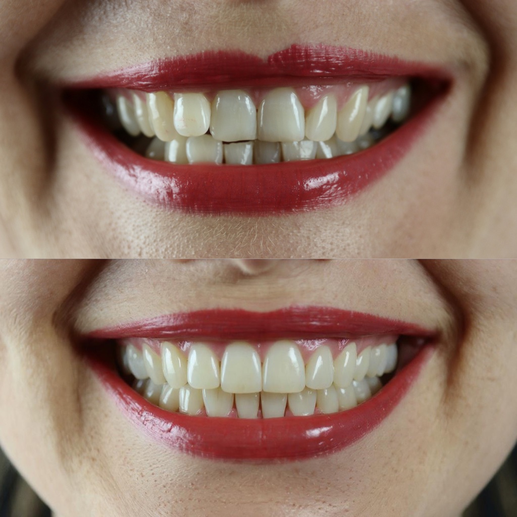 Perfect Teeth - Advanced Image Enhancement